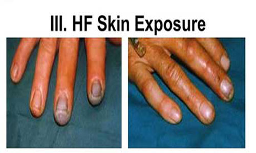 تماس HF با پوست